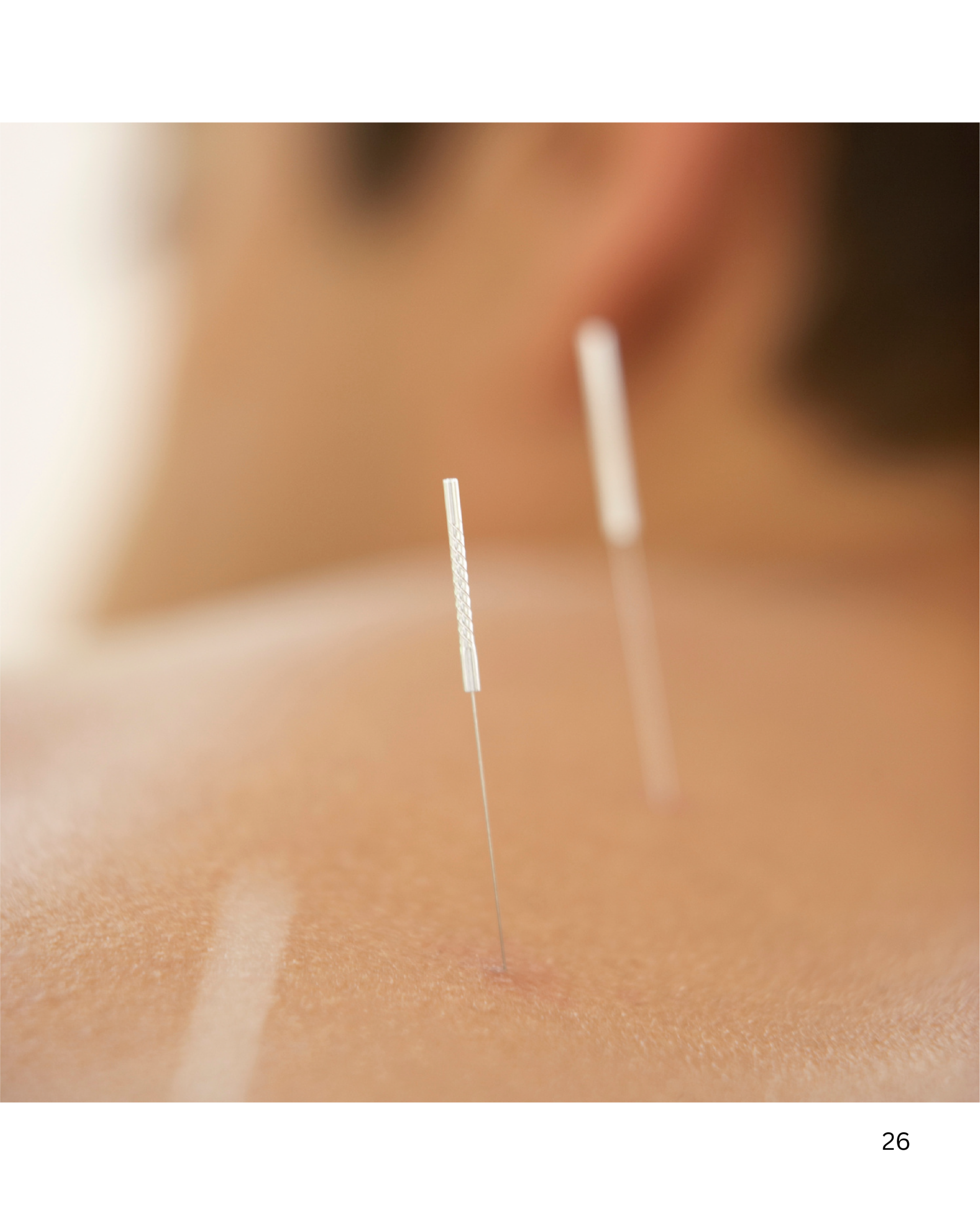 Acupuncture Support
